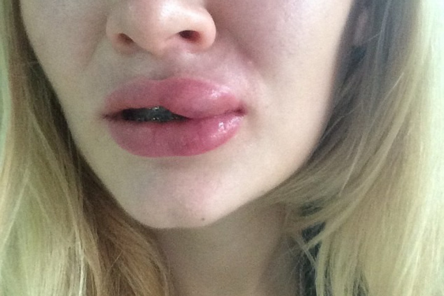 Nepavykusi injekcija į lūpas subjaurojo merginos veidą.<br>„Facebook“ nuotr.