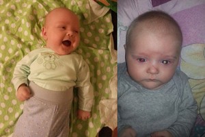 Akies vėžys toliau negailestingai drasko keturių mėnesių kūdikį