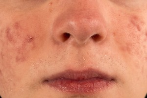 4 būdai atsikratyti nuo spuogų likusių randų