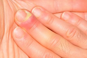 Kokias ligas išduoda įvairūs pakitimai ant nagų?