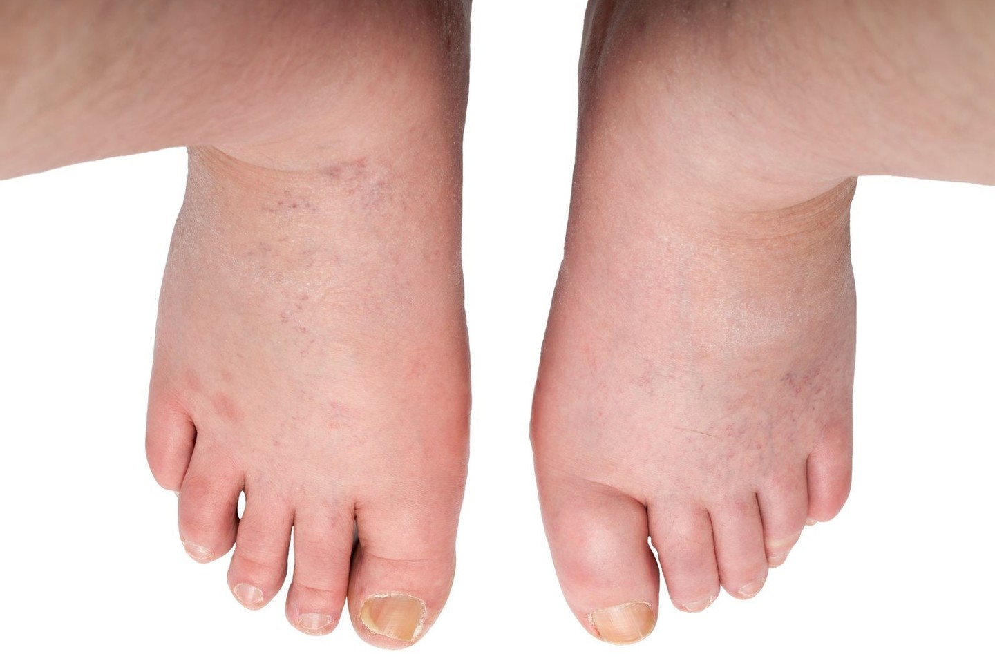 Yra daug ligų, kurios gali sukelti kojų tinimą.<br>123rf nuotr.