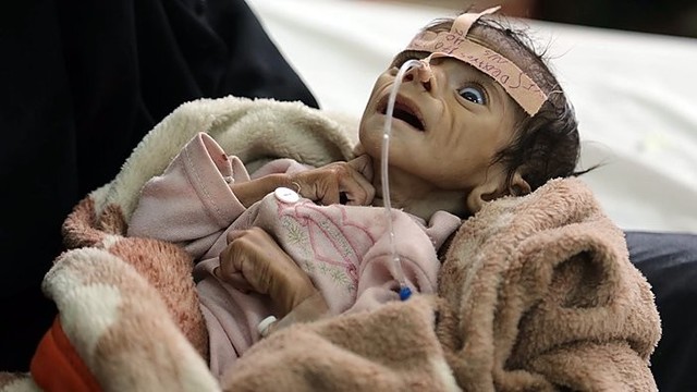 Kova su sukilėliais Jemene pražudė tūkstančius badaujančių vaikų