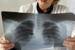 Prabilo tuberkulioze vaikus užkrėtęs mokytojas iš Klaipėdos