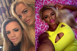 Dėl plastinių operacijų pamišusi duktė iš kelio išvedė ir mamą