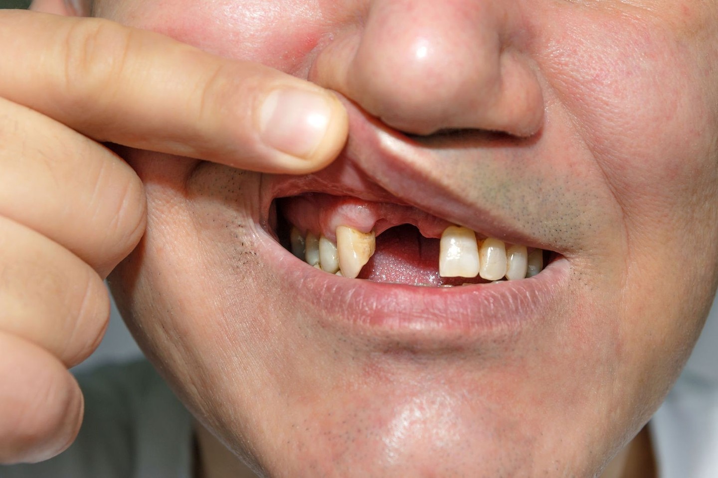 Išsimušus dantį ir laiku nesikreipus į burnos chirurgą, pacientas rizikuoja visai netekti danties<br>123rf.com