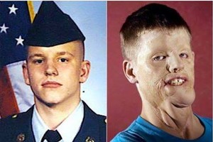 Vyras dėl naujo veido pasiryžo visą gyvenimą gerti vaistus