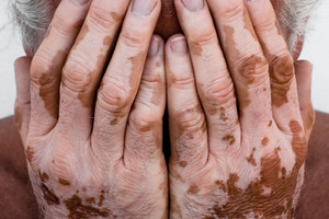 Dėl šios ligos kaunietei tenka atsakinėti į nepatogius klausimus