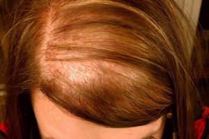 Plikimas – ir moterų problema. Ar įmanoma tai sustabdyti?