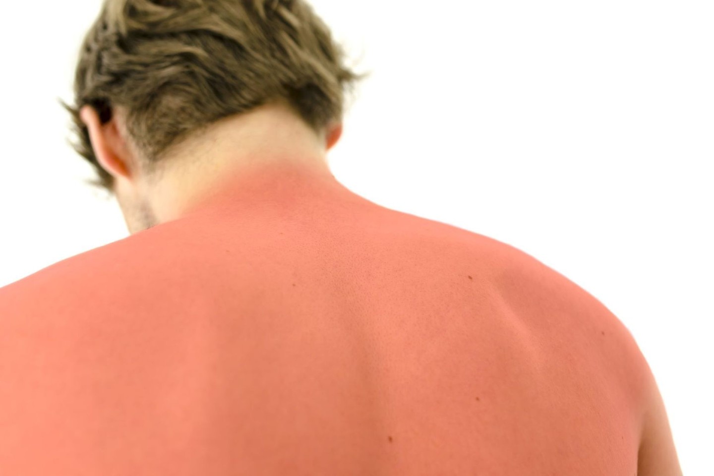 Sveikatos priežiūros specialistai pabrėžia, jog saulė spinduliuoja įvairaus ilgio ultravioletinius (UV) spindulius. Odos nudegimus sukelia ultravioletiniai B spektro saulės spinduliai (UVB), o ultravioletiniai A spektro saulės spinduliai (UVA) siejami su ankstyvuoju odos senėjimu bei žmogaus imuninės sistemos nusilpimu. Abi spinduliuotės rūšys didina odos vėžio išsivystymo riziką ir gali sukelti įvairias akių ligas.<br>123rf nuotr.