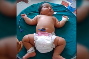 Gimė bene didžiausias kūdikis pasaulyje. Priežastys – gąsdina