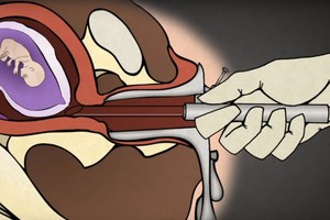 Medikai paaiškino, kaip atliekamas abortas