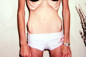 Šokiruojantys kadrai: liga, kuri nualina ne tik moteris