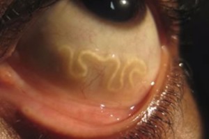 10 baisiausių pasaulio ligų, keliančių šiurpą visko mačiusiems