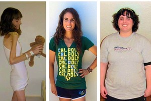 25 kilogramus svėrusi mergina nutuko. Štai kas buvo po to