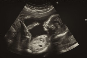 Vieno kūdikio netekusi moteris nė neįtarė, kas jos gimdoje