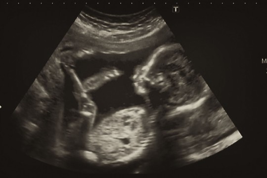 Vieno kūdikio netekusi moteris nė neįtarė, kas jos gimdoje