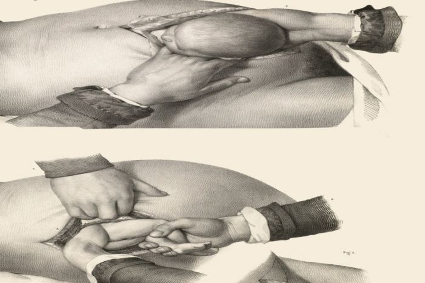 Cezario pjūvis.<br>Crucial Interventions or, An Illustrated Treatise on the Principles &amp; Practice of Surgery by Richard Barnett.