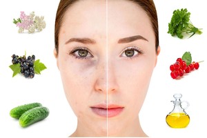 Pigmentines dėmes išbalinti padės naminės priemonės