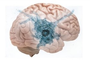 Smegenis ryjantys parazitai į organizmą pateko maudantis