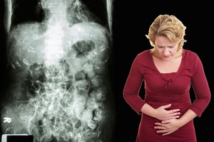 Vidurių problemos dėl nepastebėtos ligos kamuoja dešimtmečius