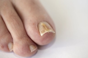 5 veiksmingi patarimai, kaip namie įveikti pėdų grybelį