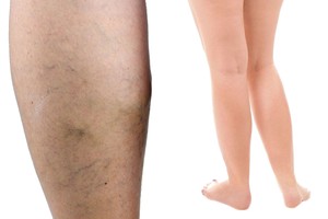 Senos močiutės receptas padės pamiršti išsiplėtusias venas