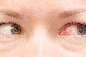 Būtina žinoti: papasakojo, kokie požymiai byloja apie akių ligas