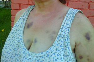 Į komą panirusios moters dukra: „Pareigūnai ją vežė karučiu“