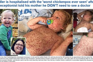 Apmaudi klaida: medikai sakė, kad šie vėjaraupiai – nieko rimta