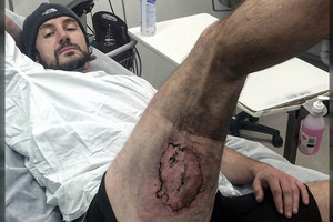 Dviratininko kišenėje sprogęs „iPhone 6“ tiesiog lydė jo odą