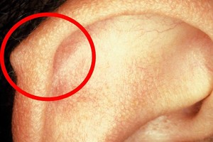 Jei turite ant ausies tokį gumbelį, štai ką tai reiškia