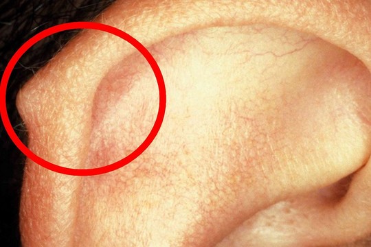 Jei turite ant ausies tokį gumbelį, štai ką tai reiškia