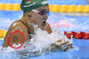 Matėte mėlynes ant Rūtos Meilutytės kūno? Štai ką jos reiškia