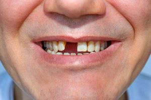 Iškritę dantys ir kiti košmarai: nustatytos tikrosios reikšmės