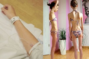 Mergina kasdien valgė po vieną persiką – pasekmės šokiruoja