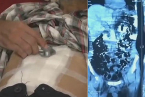 Medikai liko šokiruoti, išvydę radinį vyro pilve