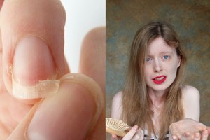 Slenkantys plaukai ir lūžtantys nagai: kokių vitaminų trūksta?