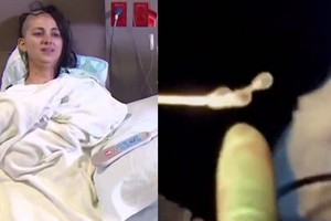 Galvos skausmai kankino 9 mėnesius, o radinys joje – pribloškė