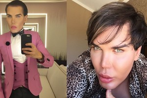 Nosies vos nepraradęs vyras lėlė R.Alvesas persisodino plaukus