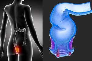 Norite išvengti hemorojaus? Pakeiskite vieną įprotį