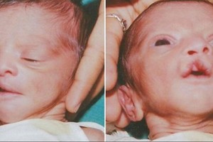 Atsakomybės stoka: šalyje gimė trys sifiliu užkrėsti kūdikiai