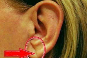 Pastebėjote tai ant savo ausų? Metas skubėti pas gydytoją