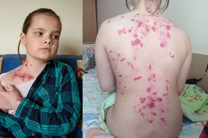 Vienuolikmetės iš Rudaminos kūną paženklino itin reta kankinanti liga