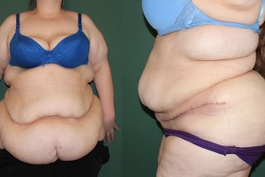 Sukrečianti lietuvės išpažintis: atsikračius svorio gyvenimas tapo pragaru