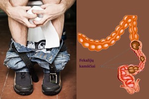 Visa nemaloni tiesa apie vidurių užkietėjimą