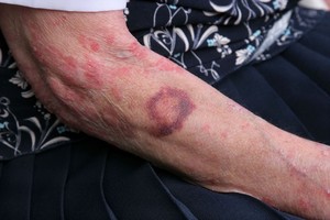 Širdininkai gydomi senais vaistais: mirtis gresia net susimušus koją