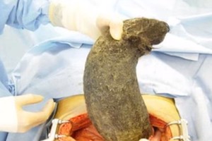 Medikai apstulbo išsiaiškinę, kas sutrikdė moteriai virškinimą