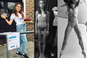25 kg svėrusi balerina atskleidė, kaip pavyko išsivaduoti iš anoreksijos gniaužtų