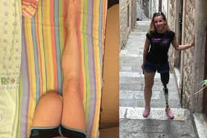 Dėl gripo komplikacijų panirusi į komą vilnietė atsibudo be kojos