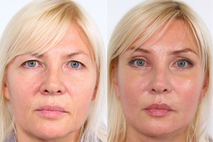 Emigrantė: „Plastinė operacija – geriausia dovana sau jubiliejaus proga“